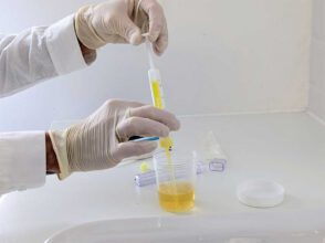 Alkoholabstinenz mit Urinscreening - Abstinenznachweis für ETG