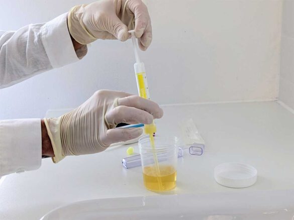 Alkoholabstinenz mit Urinscreening - Abstinenznachweis für ETG